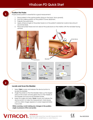 1 Position the Probe Proper probe position is essential for a good measurement: 1. 2. 3. 4. 5. Place patient in the supine position (lying on the back, face upward). Find the midline position on the patient’s lower abdomen. Palpate the pubis bone. Apply ultrasound gel on the probe head or on the patient’s abdomen (walnut size amount recommended). Place the probe head one inch above the pubis bone on the midline with the red label facing upward. 1” Pubis Bone Pubis Bone Bladder 2 Locate and Scan the Bladder 1. 2. 3. Select Start or press and release the device button to locate the bladder. Angle the probe so that the bladder takes up the largest area on the screen and the green line is in the middle of the bladder and around the bladder border. Keep this angle and select Scan or press and release the device button to make the measurement. Hold steady until two static images appear on screen (approximately 3 seconds). While scanning, avoid making any changes in the position, angle or pressure of the scan probe. VITACON US 600 Twelve Oaks Center Drive, Suite 685, Wayzata MN 55391 (800) 757-8450 | sales@Vitacon.us | www.Vitacon.us Rev 06252018