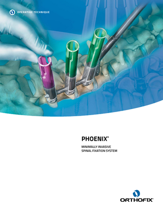 OPERATIVE TECHNIQUE  PHOENIX® MINIMALLY INVASIVE SPINAL FIXATION SYSTEM  